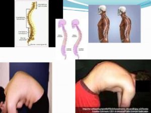 Artroza mainilor: de ce apare si cum se trateaza, Dureri de tuse în articulațiile mâinilor